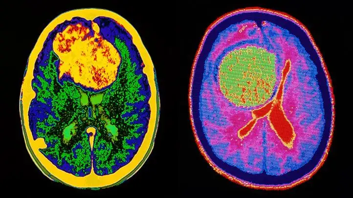 هل ورم المخ يؤدي إلى الوفاة ؟